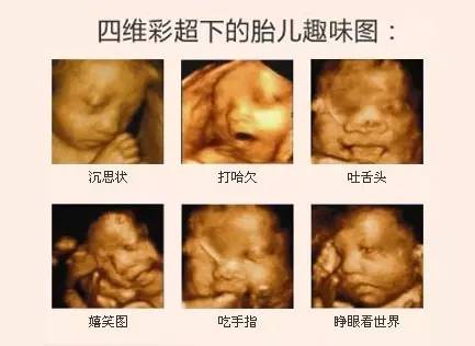 2、女胎儿四维彩超图片:四维彩超男女图区别