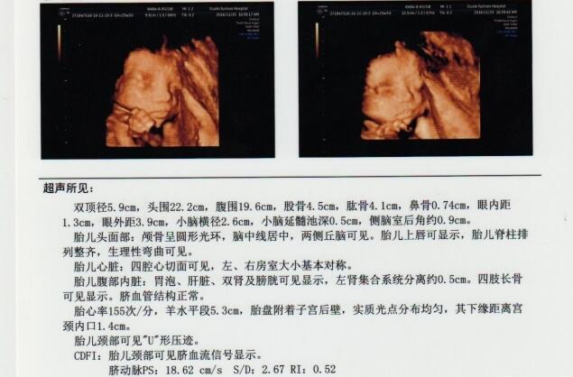 1、女胎儿四维彩超图片:怀孕20周胎儿四维彩超图是什么样子的？