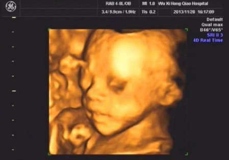 4、女胎儿四维彩超图片:四维彩超看胎儿性别