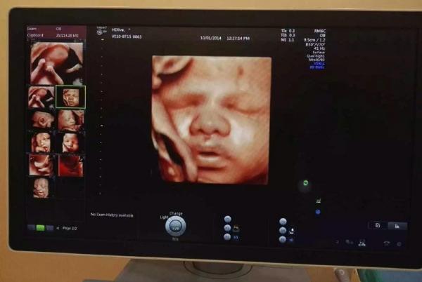 5、女胎儿四维彩超图片:四维彩超照片能不能看出男孩女孩