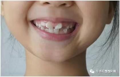 儿童10岁门牙有八字缝